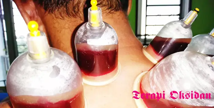 Bekam mujarab sembuhkan penyakit darah rendah