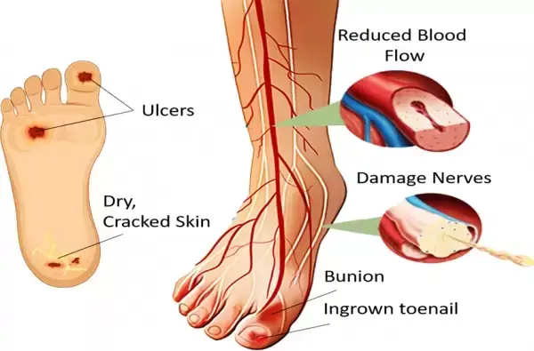 Kondisi kaki akibat terserang diabetes
